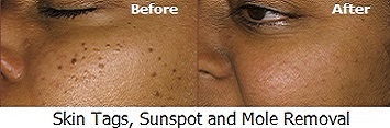 Skinsense Laser & Medical Aesthetics Specialists.  The only professional male and female skin, body and hair treatment speicialists for men and women in Port Vila, Vanuatu